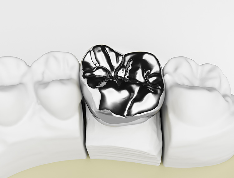 銀歯は比較的金属アレルギーを起こしやすい