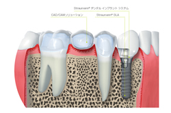 ストローマンインプラント