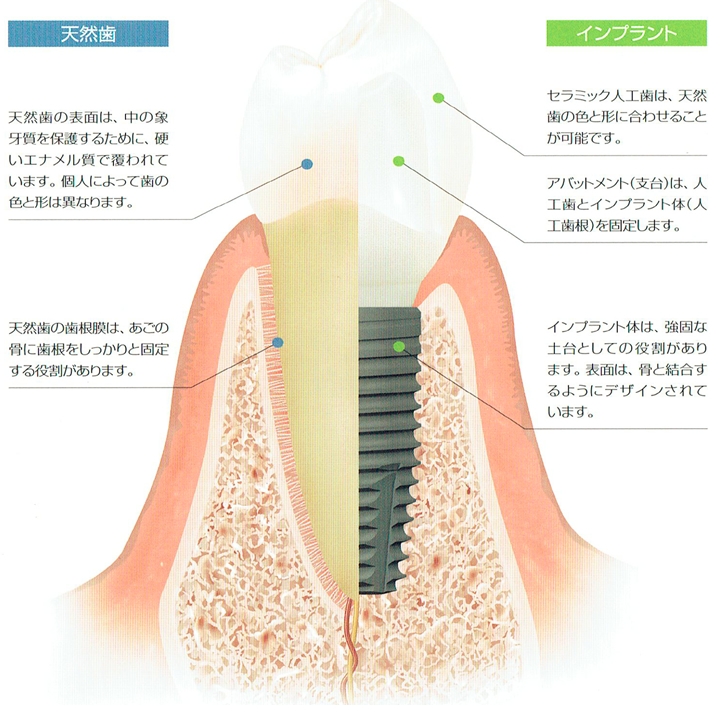 インプラントとは