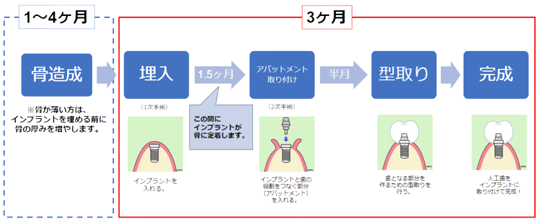 インプラント埋入から完成まで