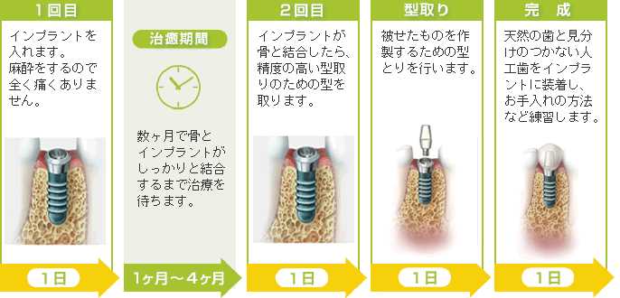 インプラント埋入から完成まで